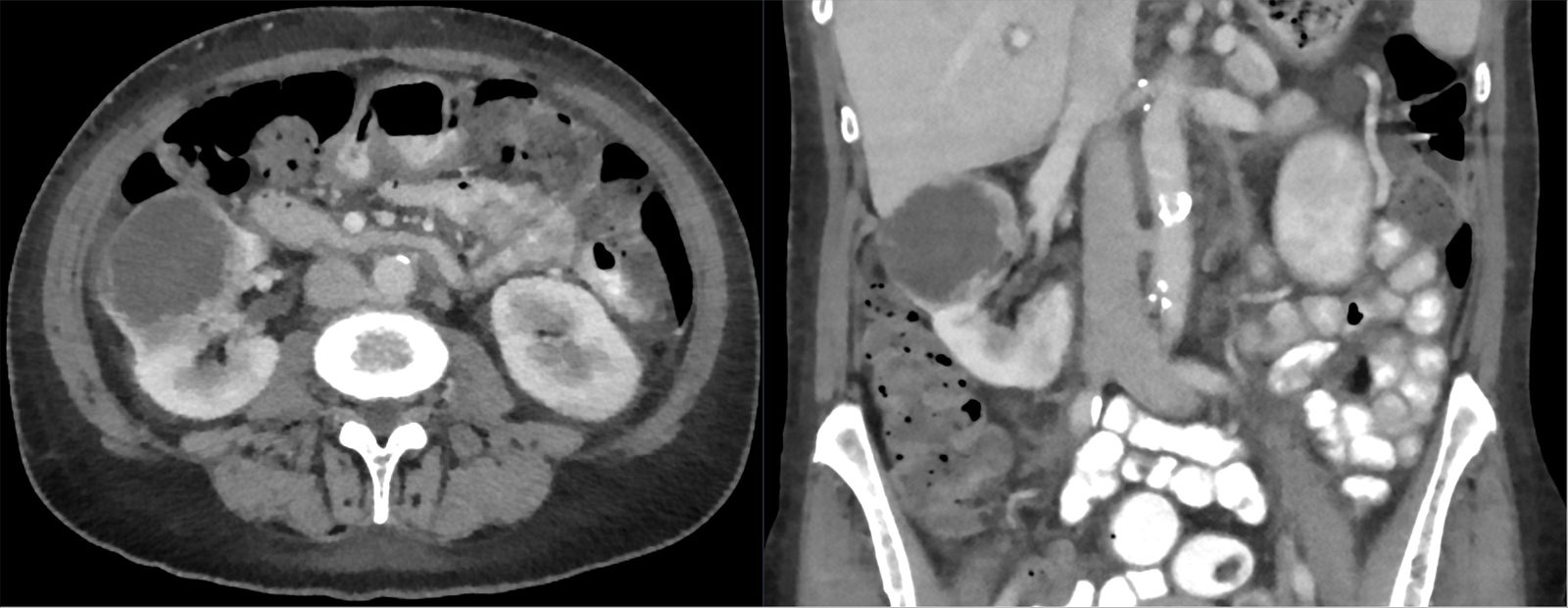 Axial and coronal contrast-enhanced CT views showing a large predominantly cystic renal cell carcinoma arising from and distorting the right kidney.
