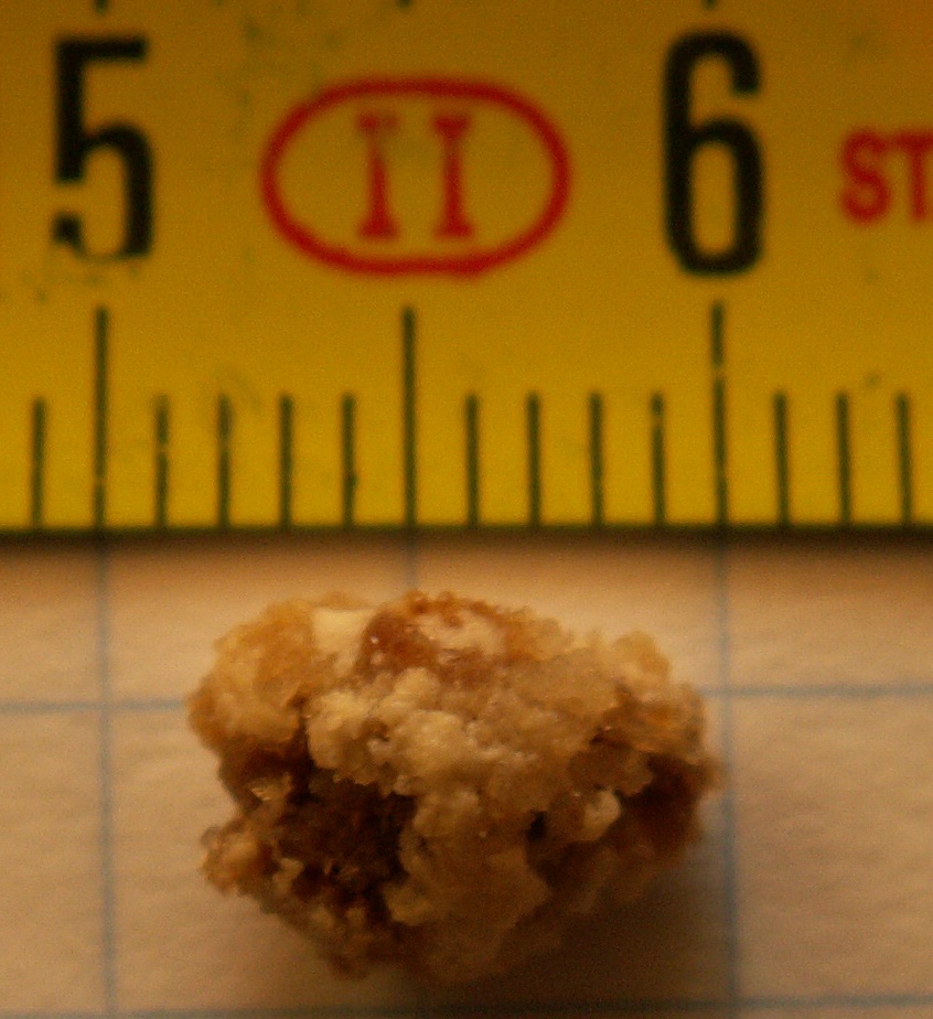 Clinical image of a passed renal calculus used to connect the physical stone with the sudden colicky loin-to-groin pain of ureteric obstruction.
