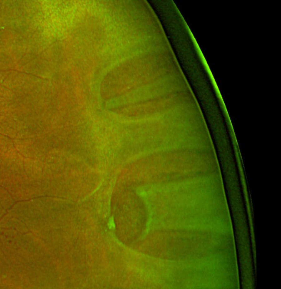Fundus photograph showing an elevated, folded, pale area of detached retina with a visible retinal tear.