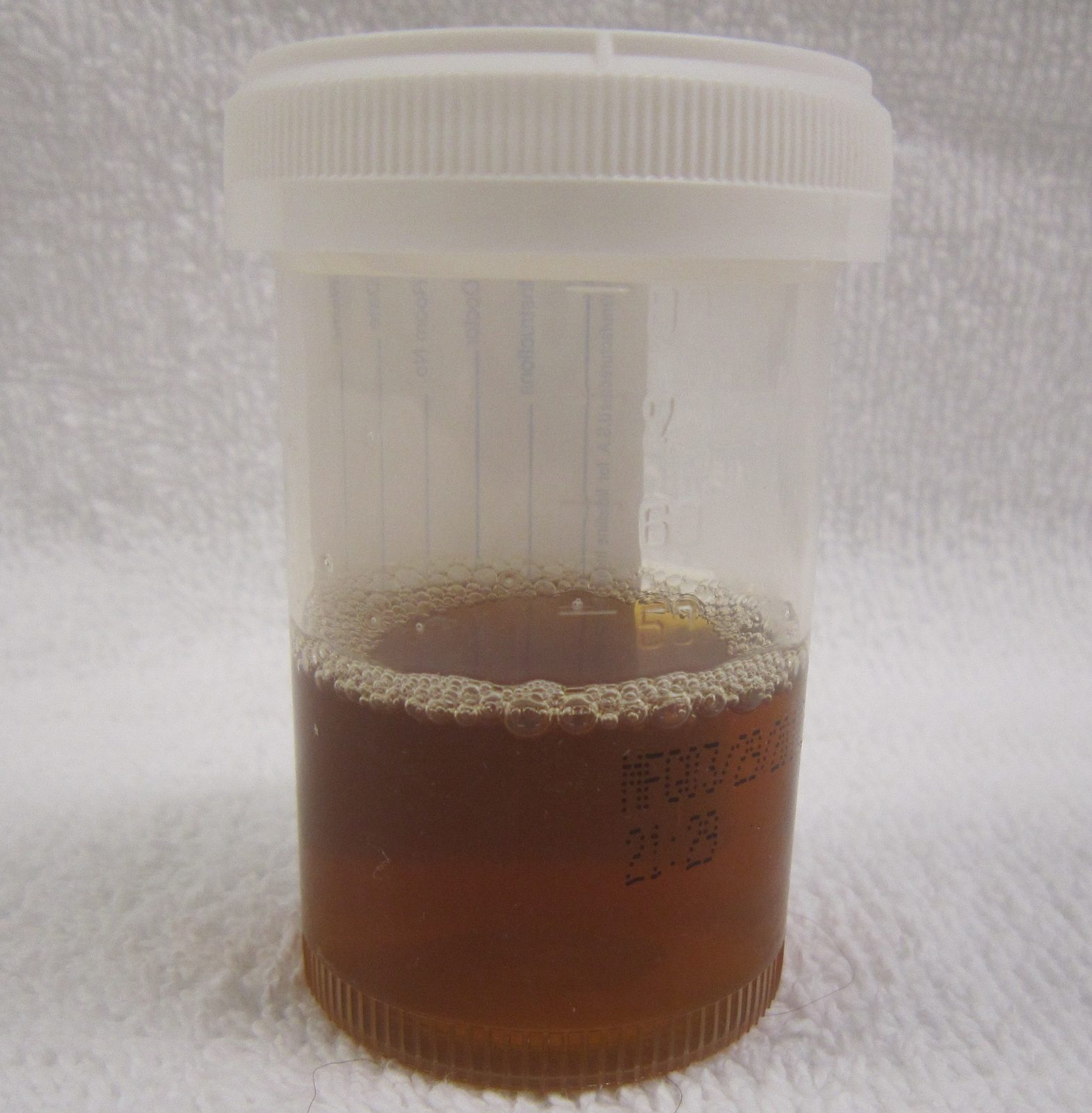 A urine specimen with the dark tea-brown appearance of myoglobinuria in rhabdomyolysis.