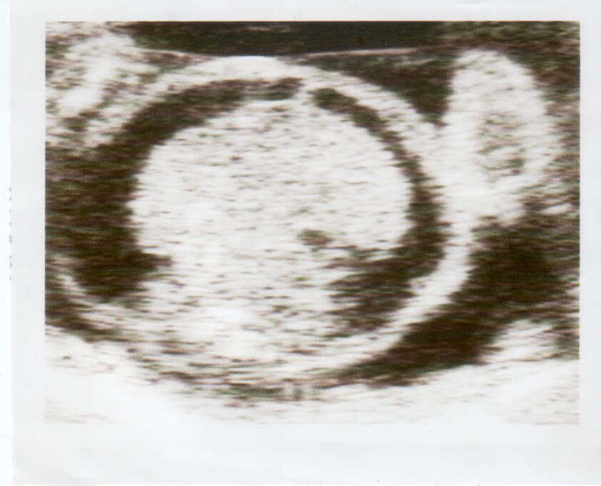 Fetal axial ultrasound showing diffuse subcutaneous oedema and fluid accumulation consistent with hydrops fetalis, a severe possible consequence of fetal anaemia.