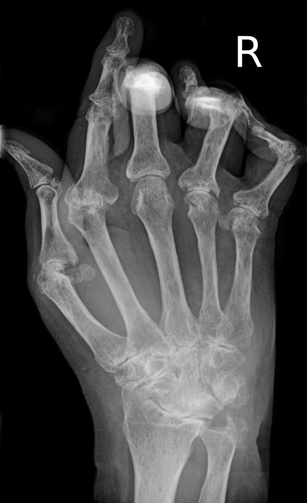 Hand radiograph showing peri-articular osteopenia and marginal erosions that may occur in established rheumatoid arthritis.