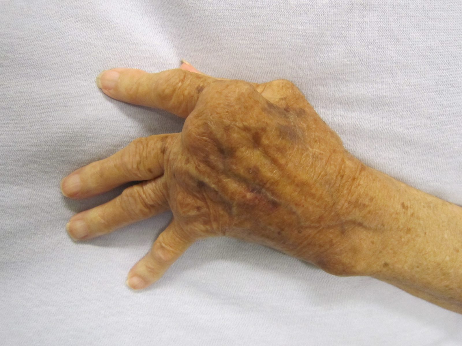 Rheumatoid arthritis of the hand with small-joint swelling and ulnar deviation, illustrating chronic inflammatory joint damage.