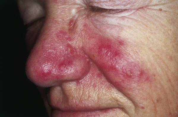 A clinical photograph showing persistent central facial erythema and telangiectasia over the nose and cheeks with scattered inflammatory papules.