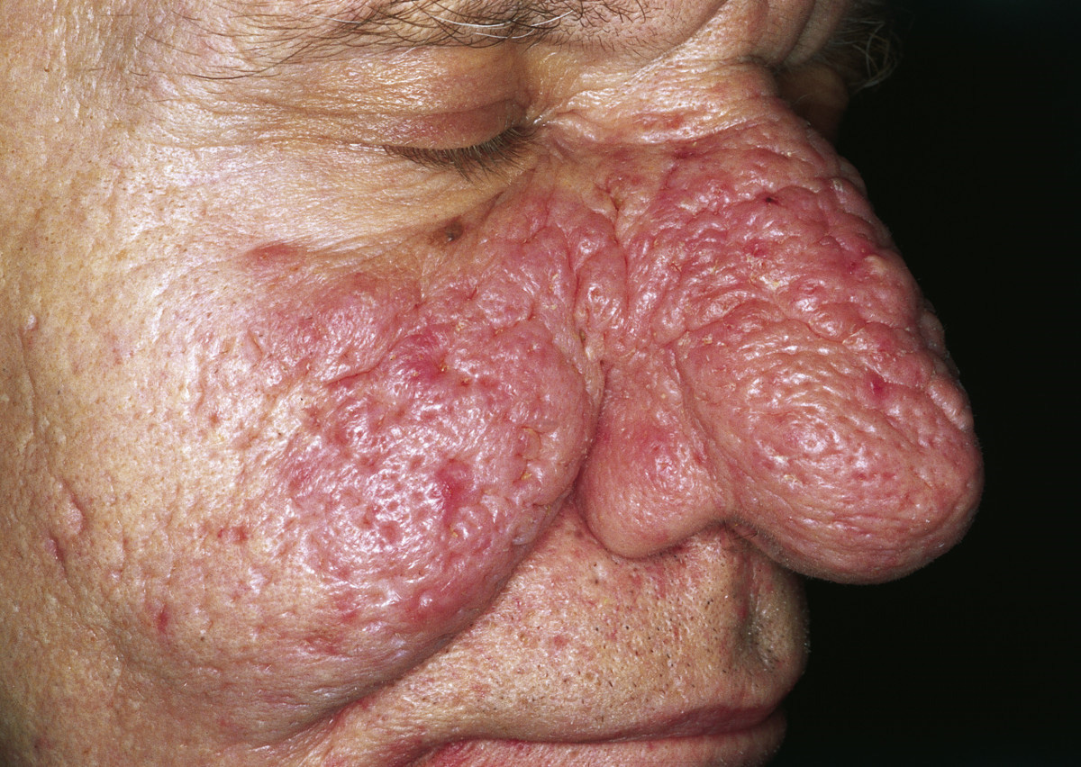 A photograph of rhinophyma showing a thickened, bulbous, enlarged nose from phymatous rosacea.