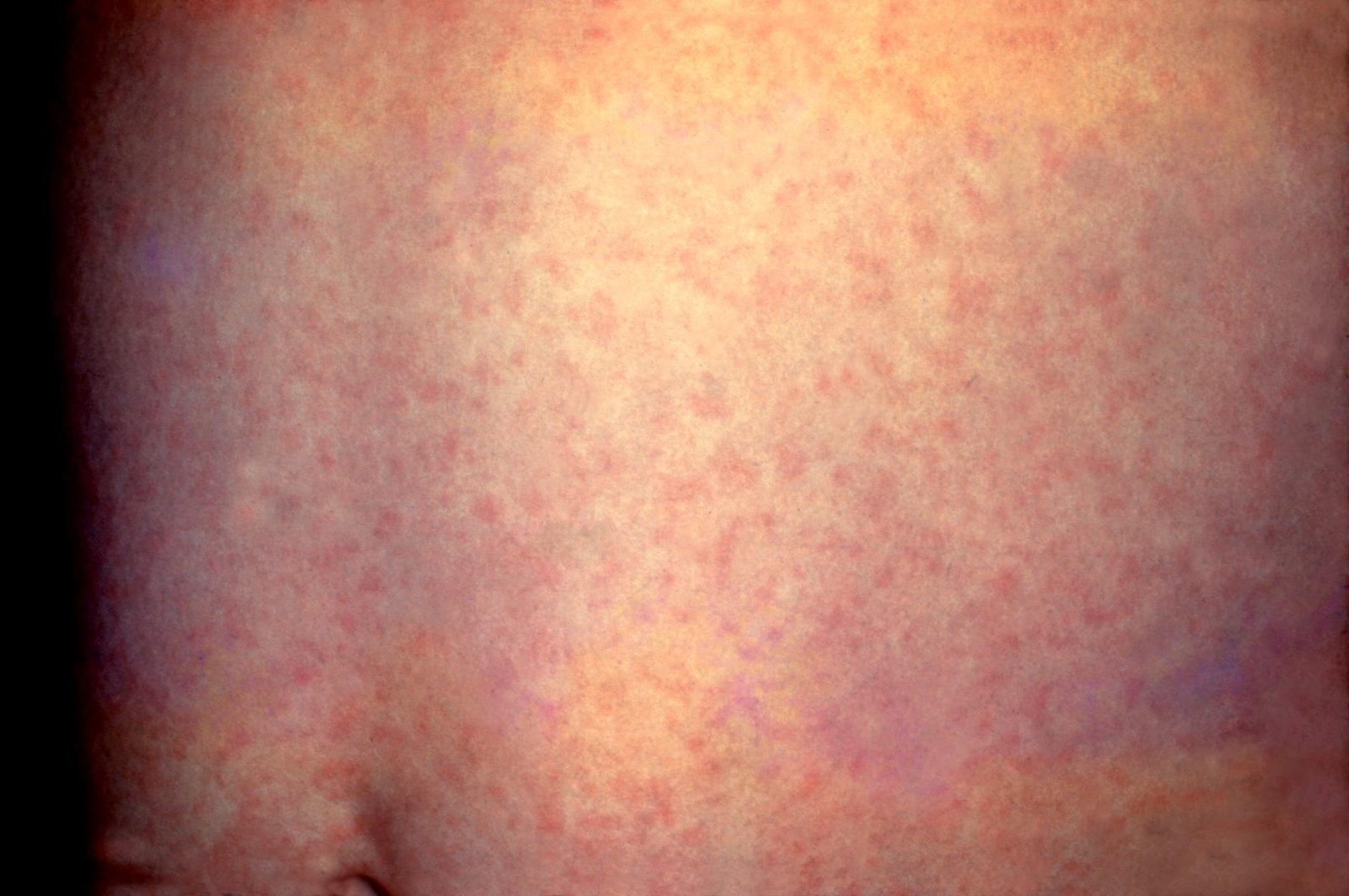 A clinical photograph showing the fine, diffuse pink maculopapular exanthem of rubella across the trunk.