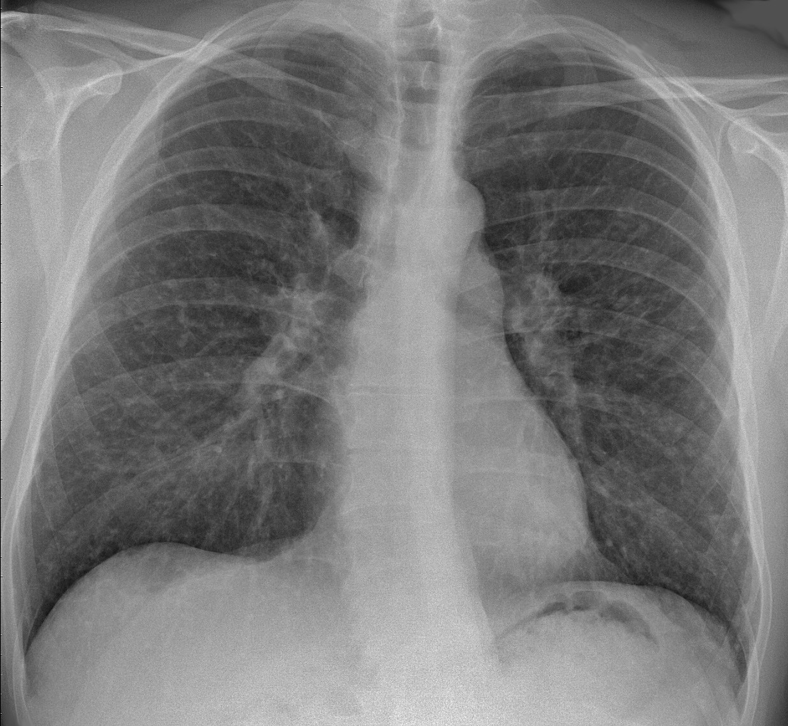 PA chest radiograph showing bilaterally prominent, lobulated hila in sarcoidosis, the classic site of bilateral hilar lymphadenopathy.