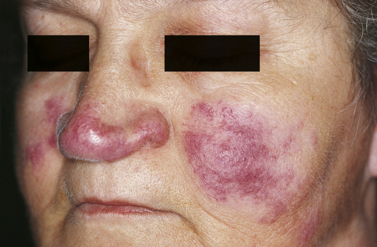 An illustration of extrapulmonary features: erythema nodosum, lupus pernio, uveitis and the multisystem distribution of granulomas.