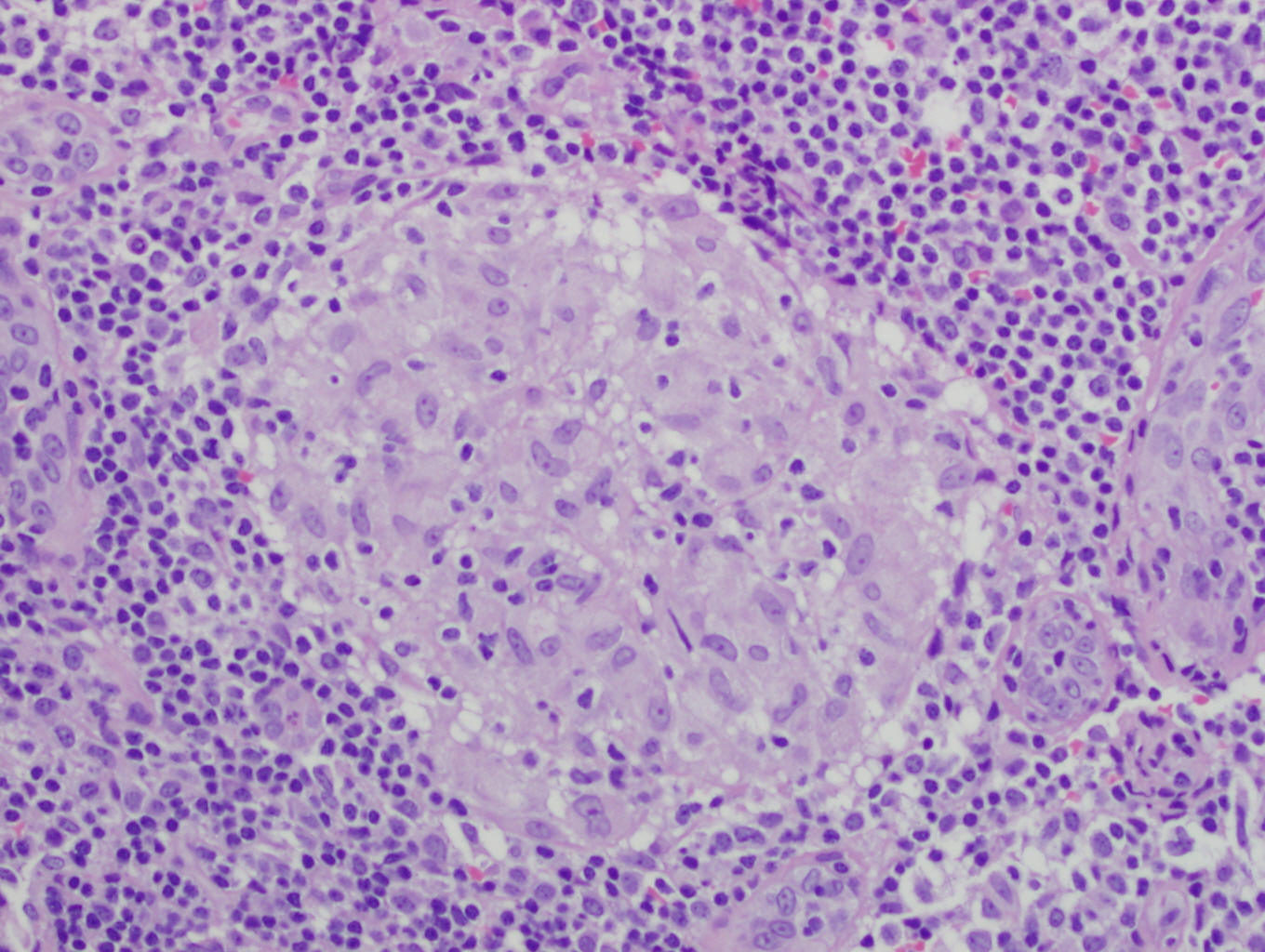 A histology image of a non-caseating (non-necrotising) granuloma with epithelioid macrophages and surrounding lymphocytes, contrasted with the caseating granuloma of tuberculosis.