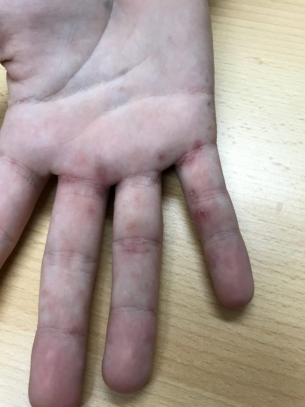 Clinical photograph showing small erythematous and excoriated scaly lesions across the palm, fingers and web spaces in scabies.