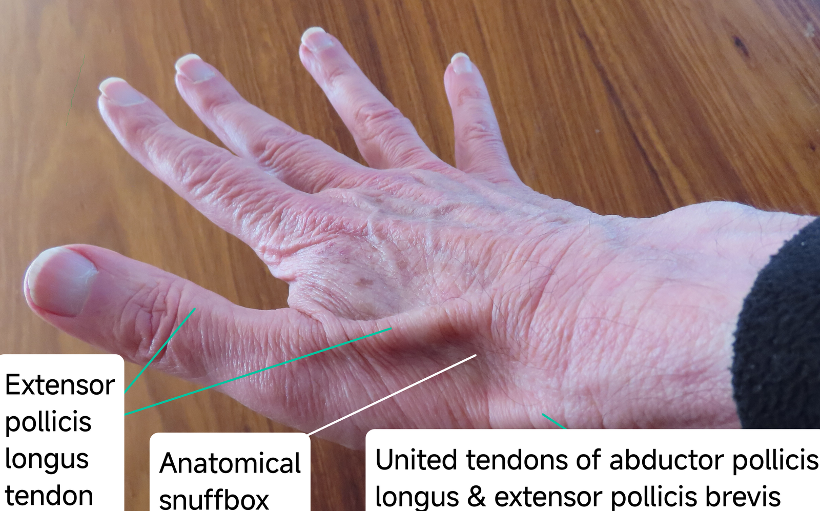 Photograph illustrating the borders and palpation point of the anatomical snuffbox on the radial wrist.