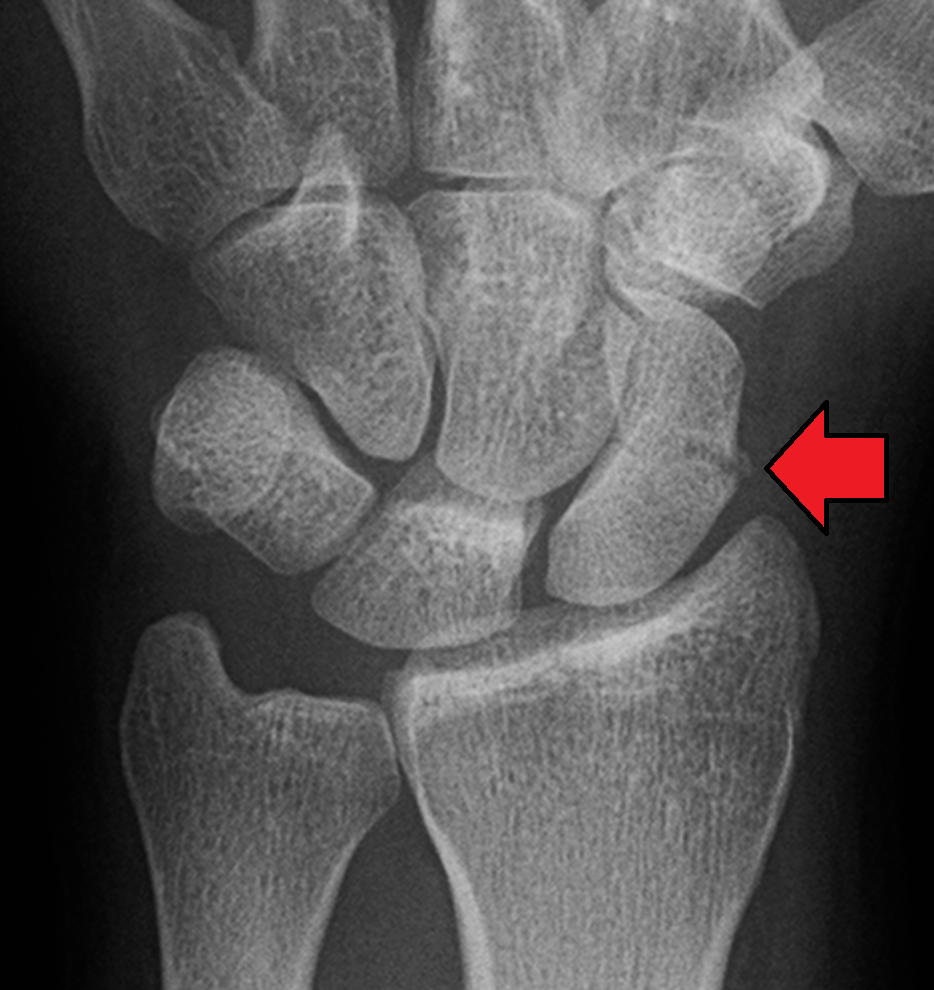 Radiograph demonstrating a fracture line across the waist of the scaphoid.