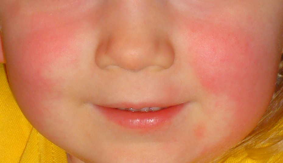 Flushed cheeks with a striking pale ring around the mouth (circumoral pallor), a characteristic facial appearance in scarlet fever.