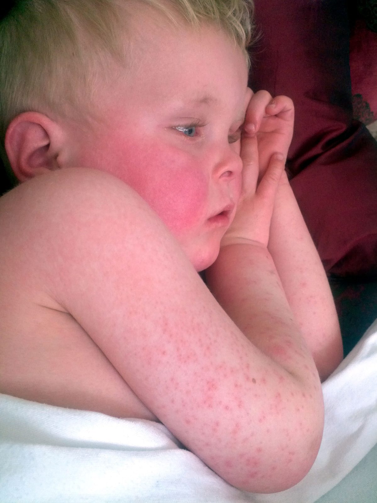 A clinical photograph of a young child with scarlet fever, showing deeply flushed cheeks and a fine, closely spaced red punctate rash over the shoulder, trunk and arm.
