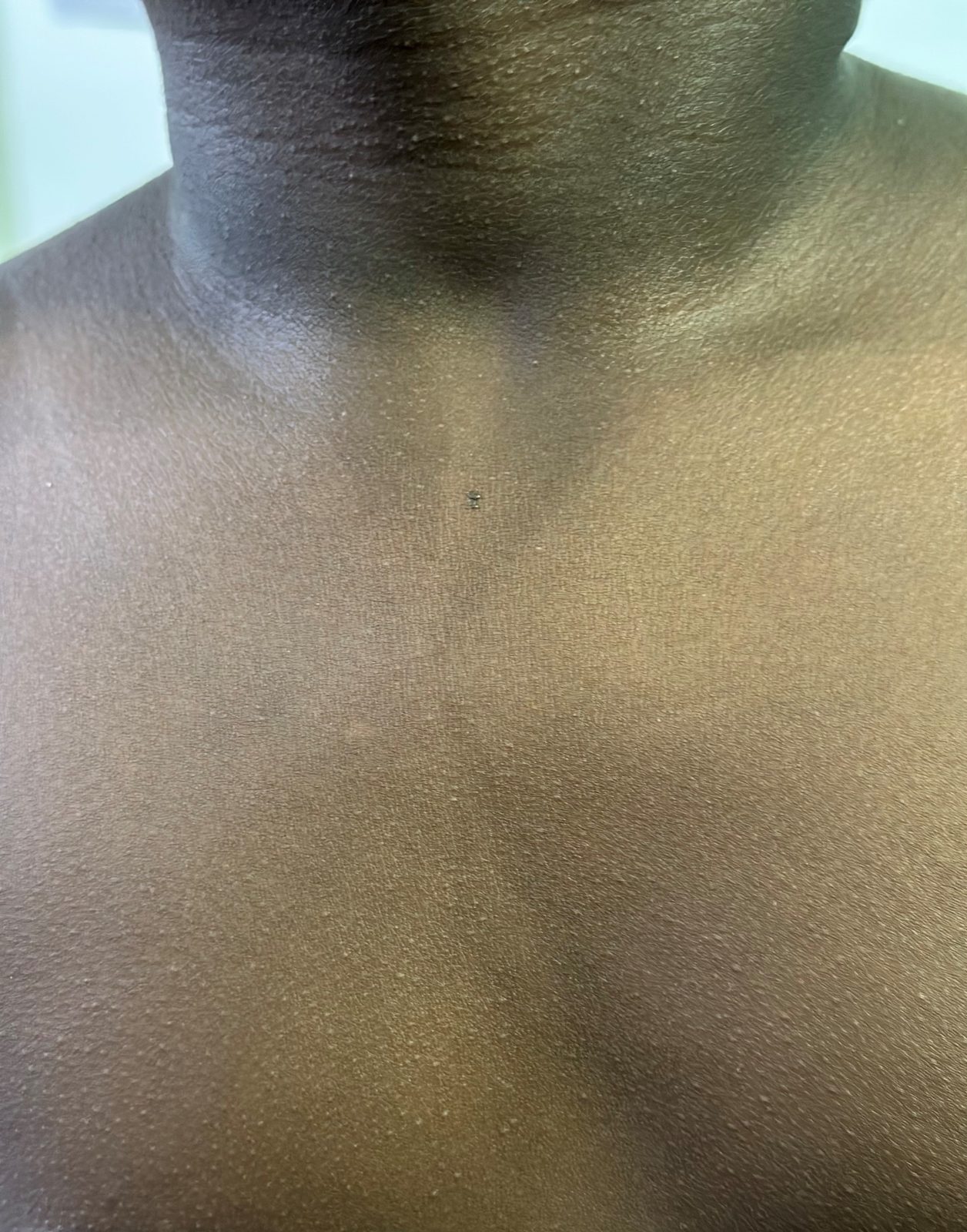 The same sandpaper rash on the neck and upper trunk of a child with darker skin. Erythema is much harder to appreciate; the fine, closely spaced papular texture is the finding to look for, and the rash is often easier to feel than to see.
