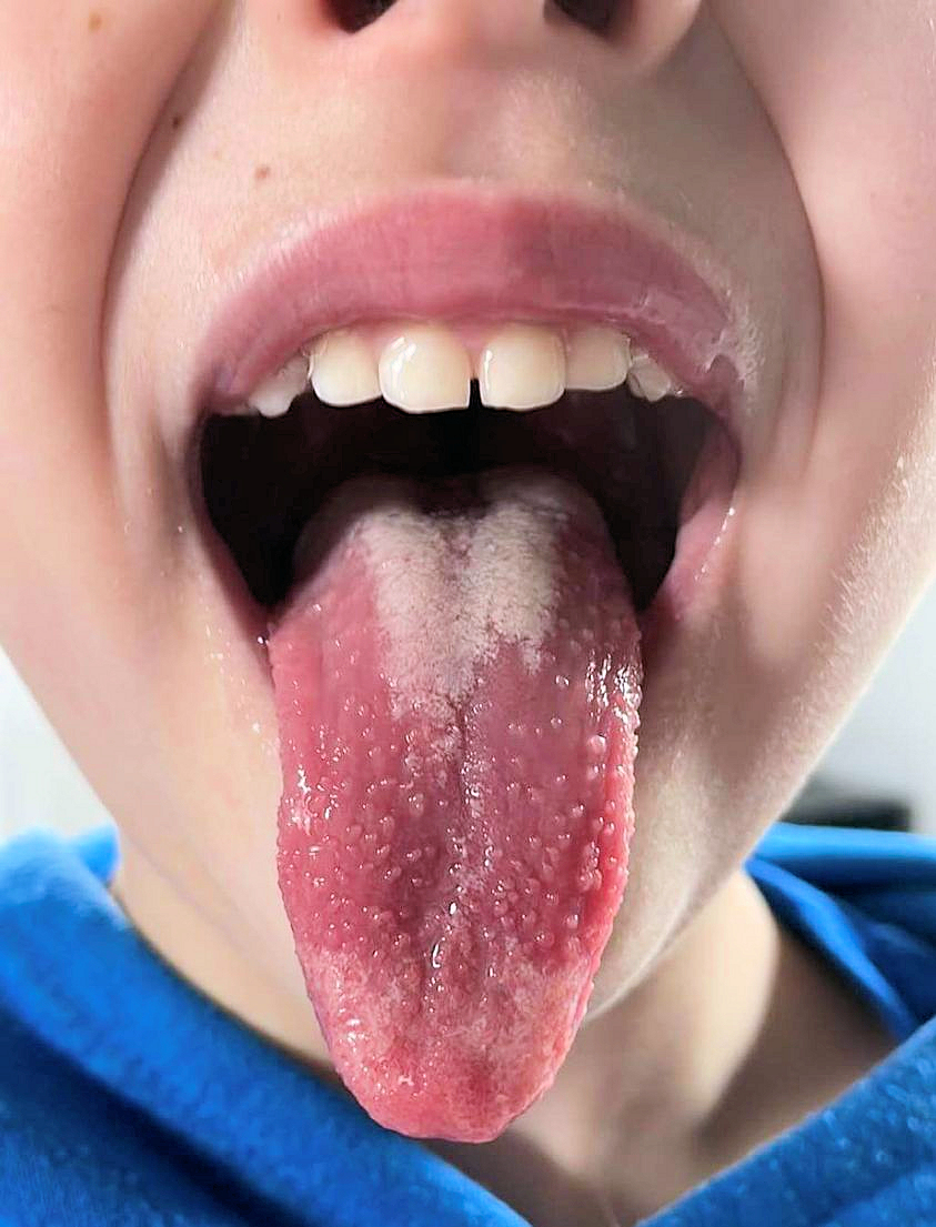 The tongue of a child with scarlet fever showing the white strawberry tongue: a white coat through which swollen red papillae project. The coat later sheds to leave the red strawberry tongue.