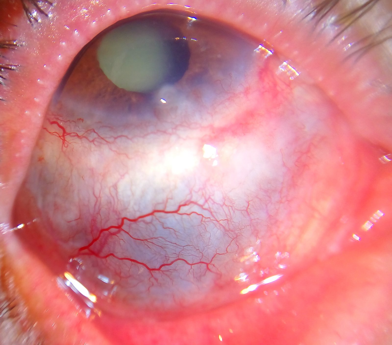 Close clinical photograph showing blue-grey scleral translucency from thinning after recurrent scleritis, with prominent superficial vessels. Label it as an example of structural damage and an ophthalmic emergency sign.