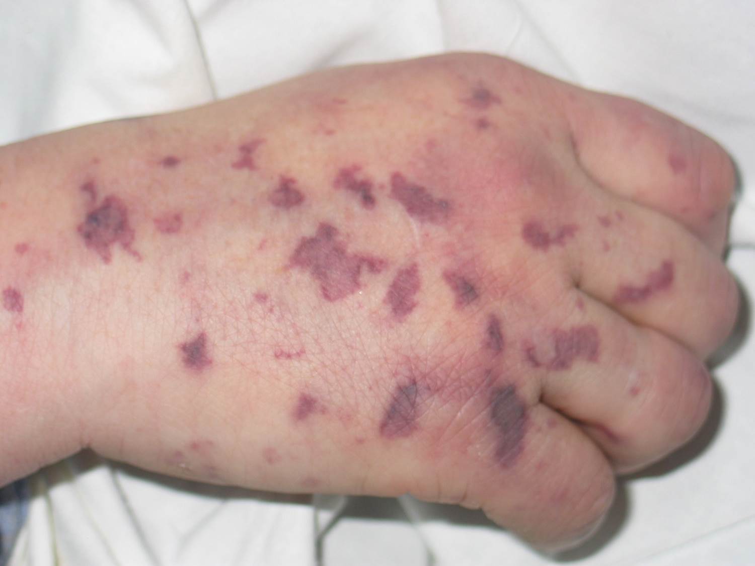 Non-blanching purpuric rash and skin microvascular injury in severe sepsis and meningococcal disease; the same rash may be harder to detect on darker skin tones.