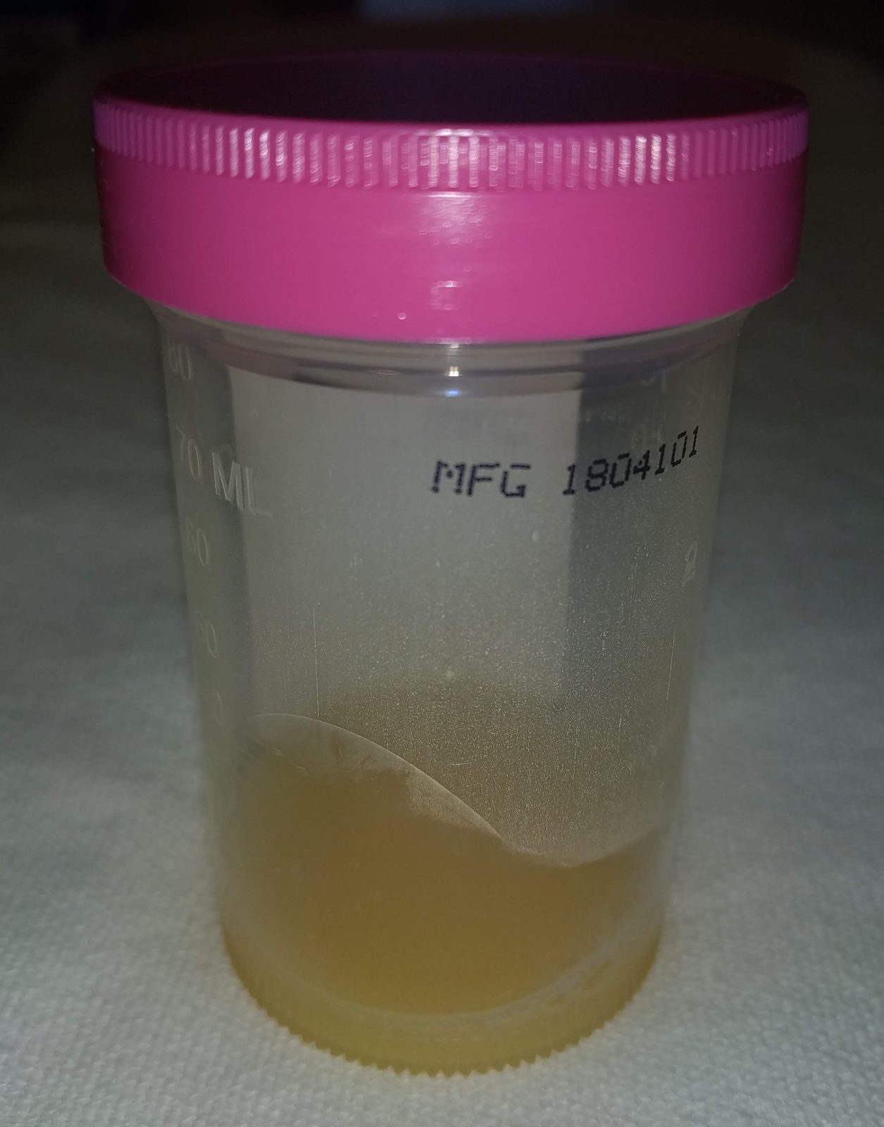 Clinical photograph of a hot, swollen knee with an effusion in a patient with suspected septic arthritis.