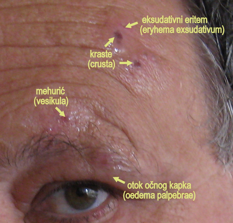 A clinical illustration of ophthalmic-division zoster with vesicles on the tip of the nose indicating nasociliary involvement and increased risk of ocular disease.
