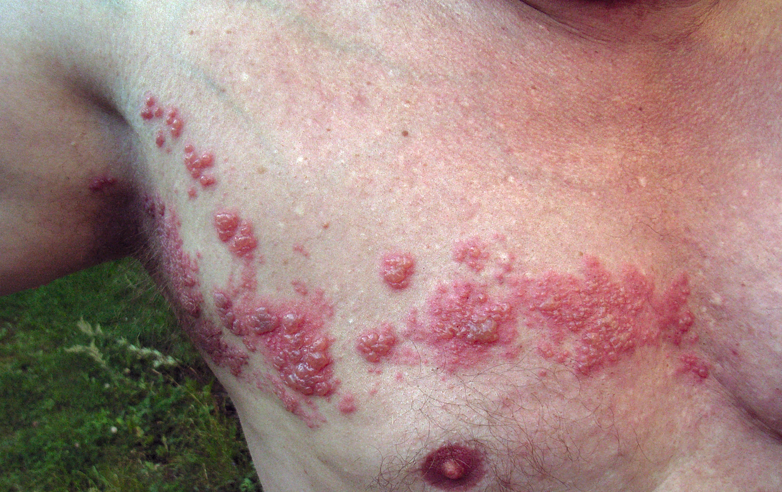 A diagram of reactivation in a single sensory ganglion producing a unilateral dermatomal vesicular rash that stops at the midline.