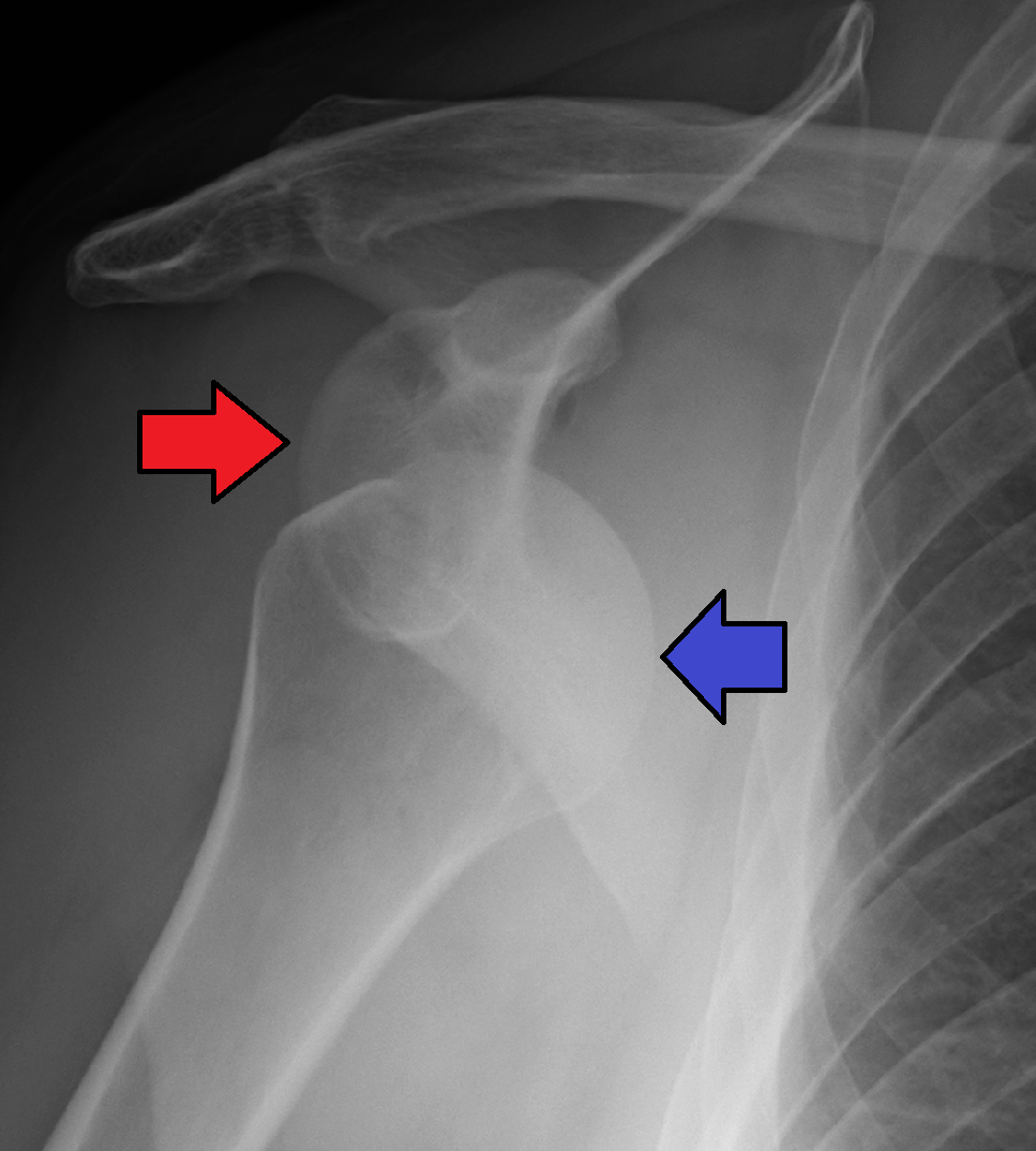 Clinical photograph showing loss of the deltoid contour and the arm held in slight abduction and external rotation.