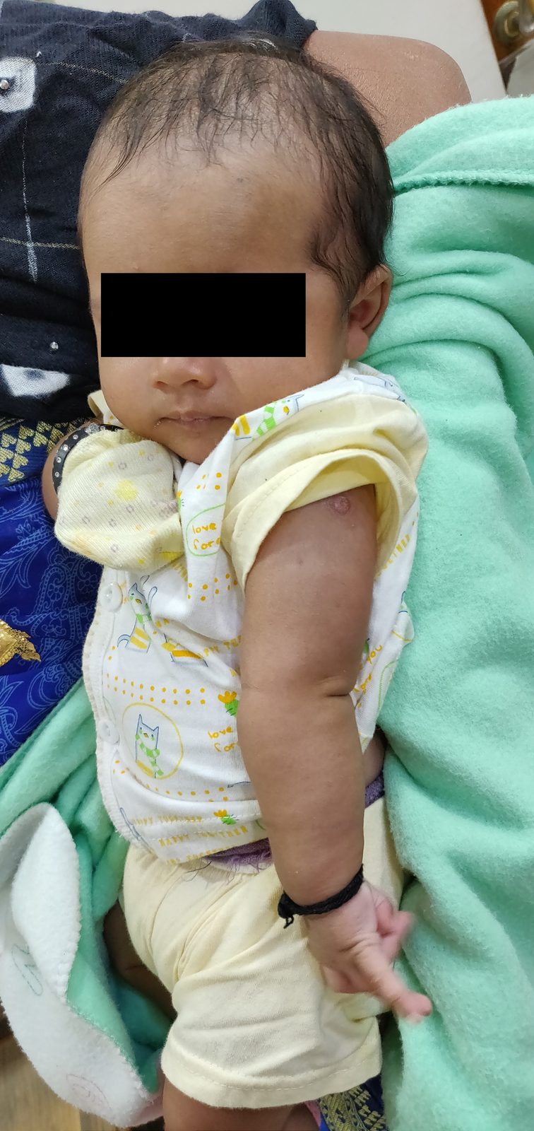 A clinical photograph of an infant with the affected arm adducted and internally rotated at the shoulder, extended at the elbow and pronated in the classic waiter's-tip posture of Erb palsy.