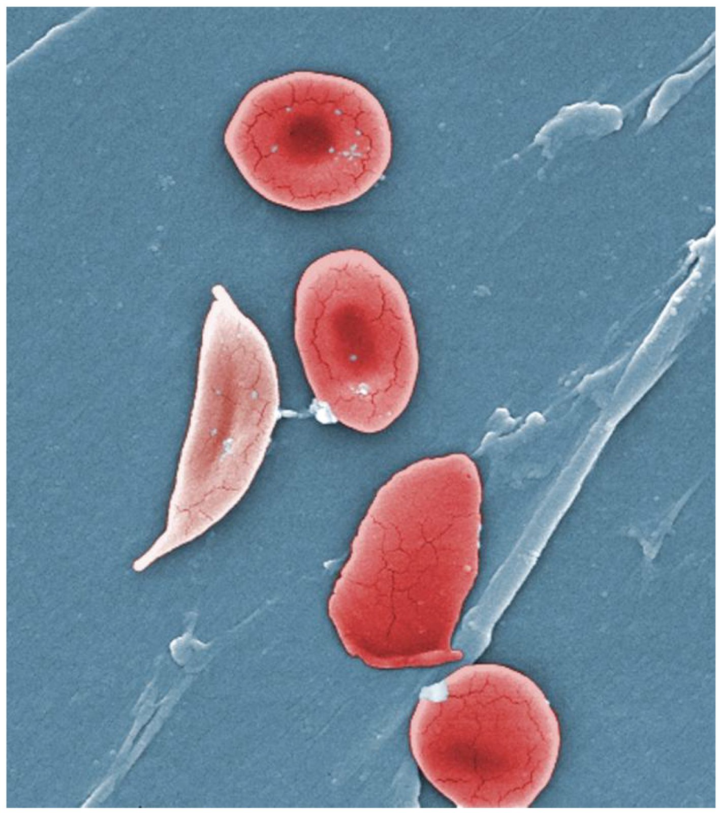 Colour-enhanced scanning electron micrograph showing a crescent-shaped sickled red cell alongside normal biconcave red cells.