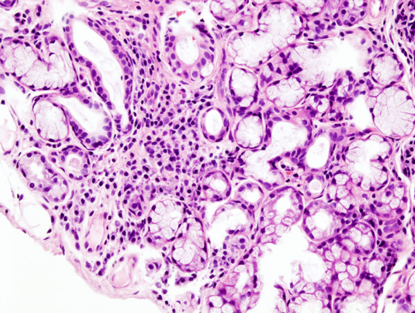 H&E micrograph of a minor salivary-gland lip biopsy showing focal lymphocytic infiltration around ducts and acini. Label the specimen as supportive diagnostic evidence and avoid implying that every patient requires biopsy.