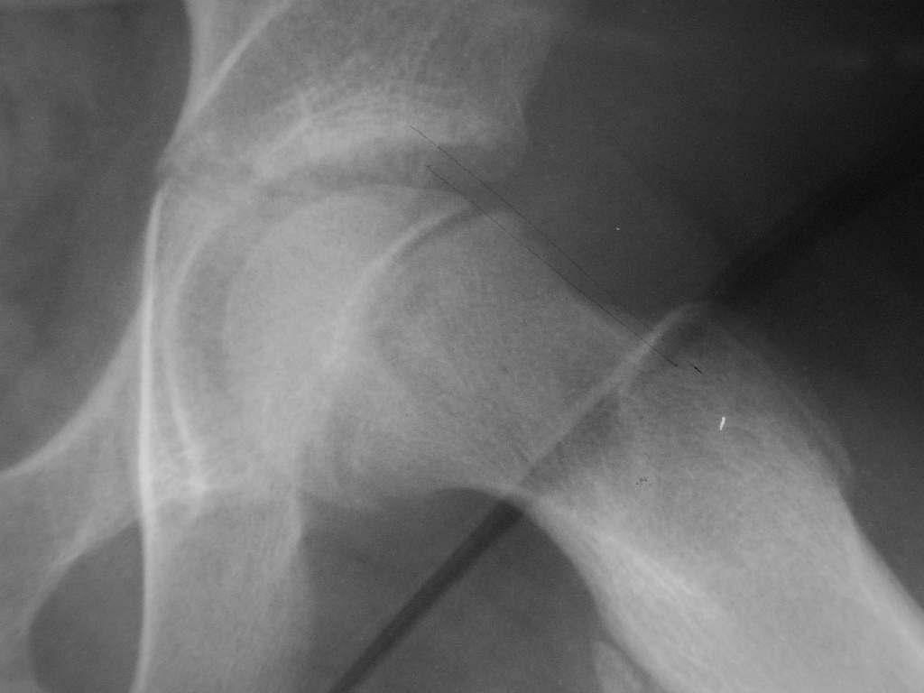 An AP pelvic radiograph with the line of Klein drawn along the superior femoral neck, showing failure to intersect the slipped epiphysis on the affected side; retain source attribution while image remediation remains separate.