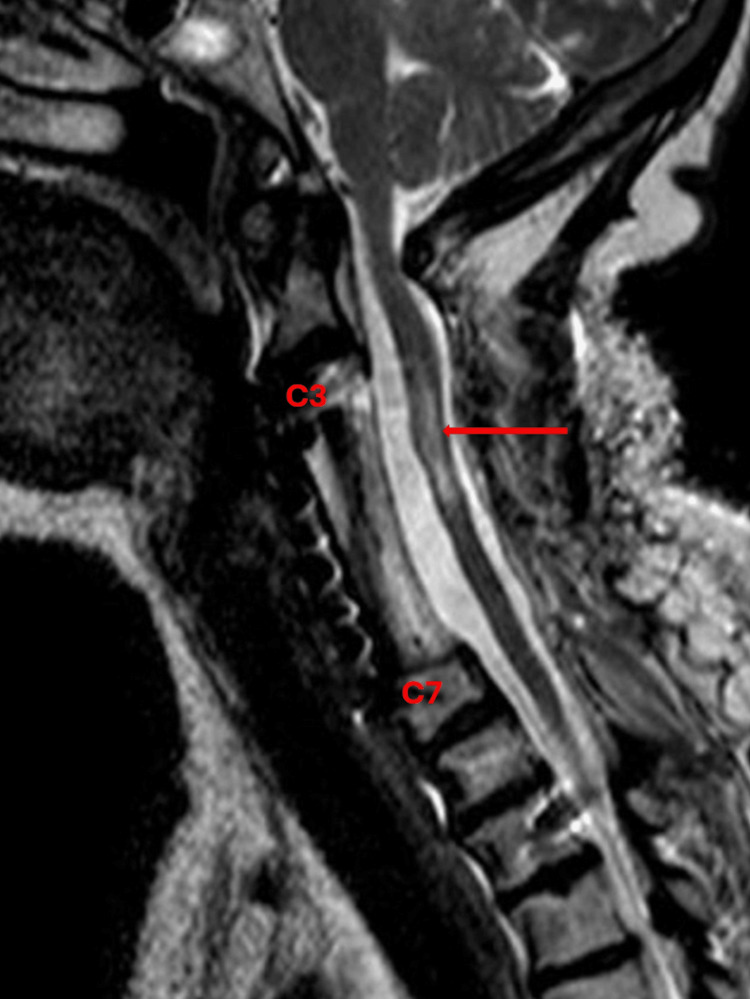 Sagittal T2-weighted cervical MRI showing focal cord hyperintensity and surrounding oedema after traumatic cord injury, with a caption reminding learners that MRI findings must be interpreted alongside the neurological examination and spinal-team plan.