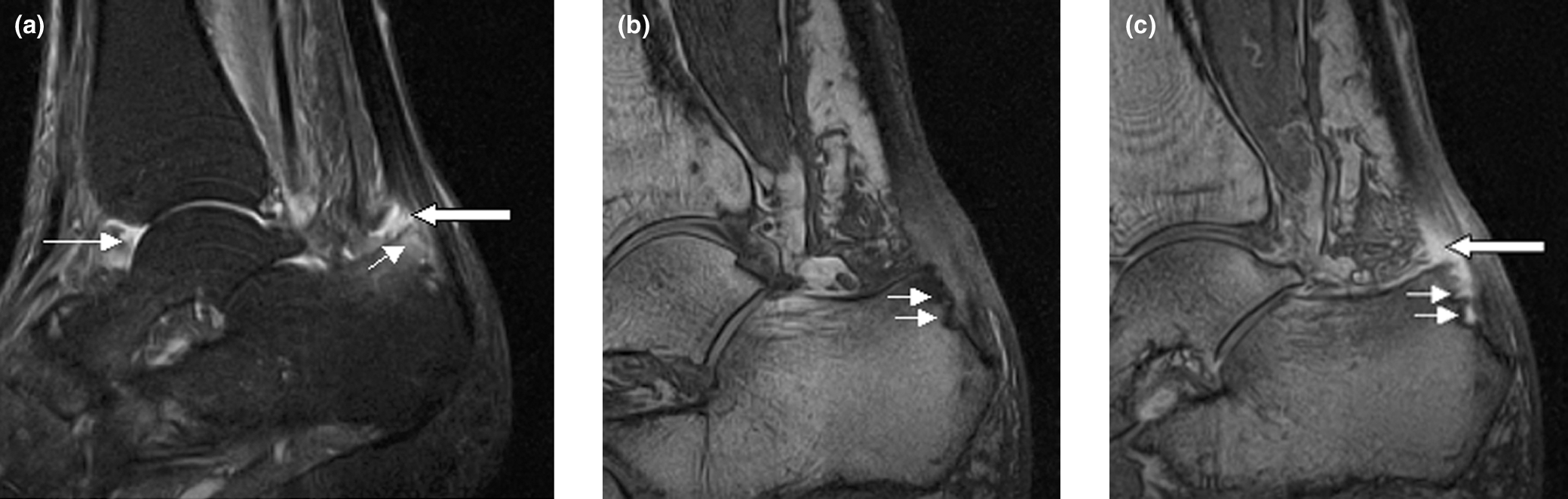 Sagittal ankle MRI sequences from psoriatic arthritis showing inflammatory change at the Achilles tendon insertion, illustrating enthesitis as a hallmark of spondyloarthropathy.