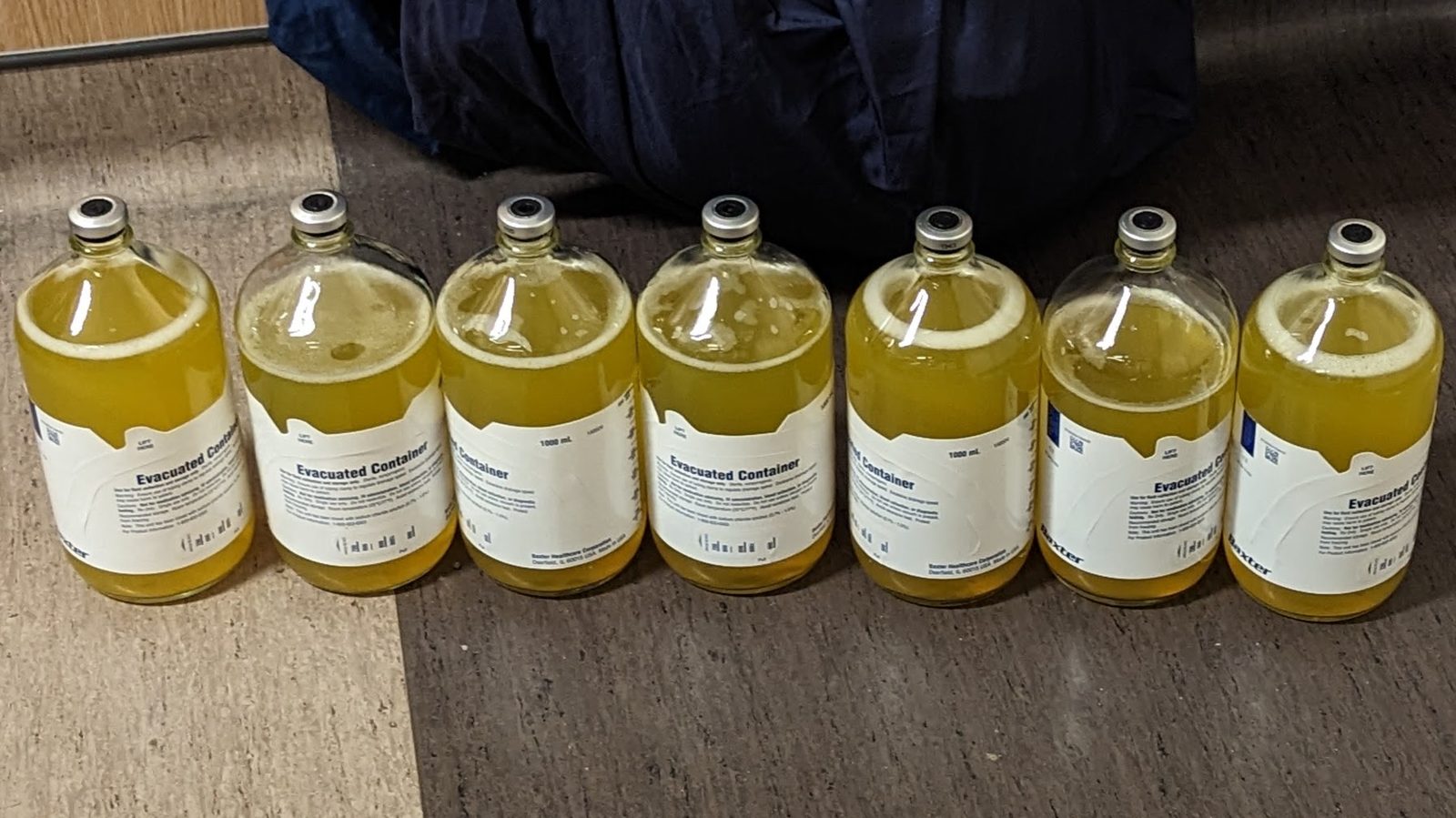 A clinical image of yellow ascitic fluid obtained at paracentesis, labelled to emphasise that visual appearance cannot diagnose or exclude SBP and that cell count and culture are required.