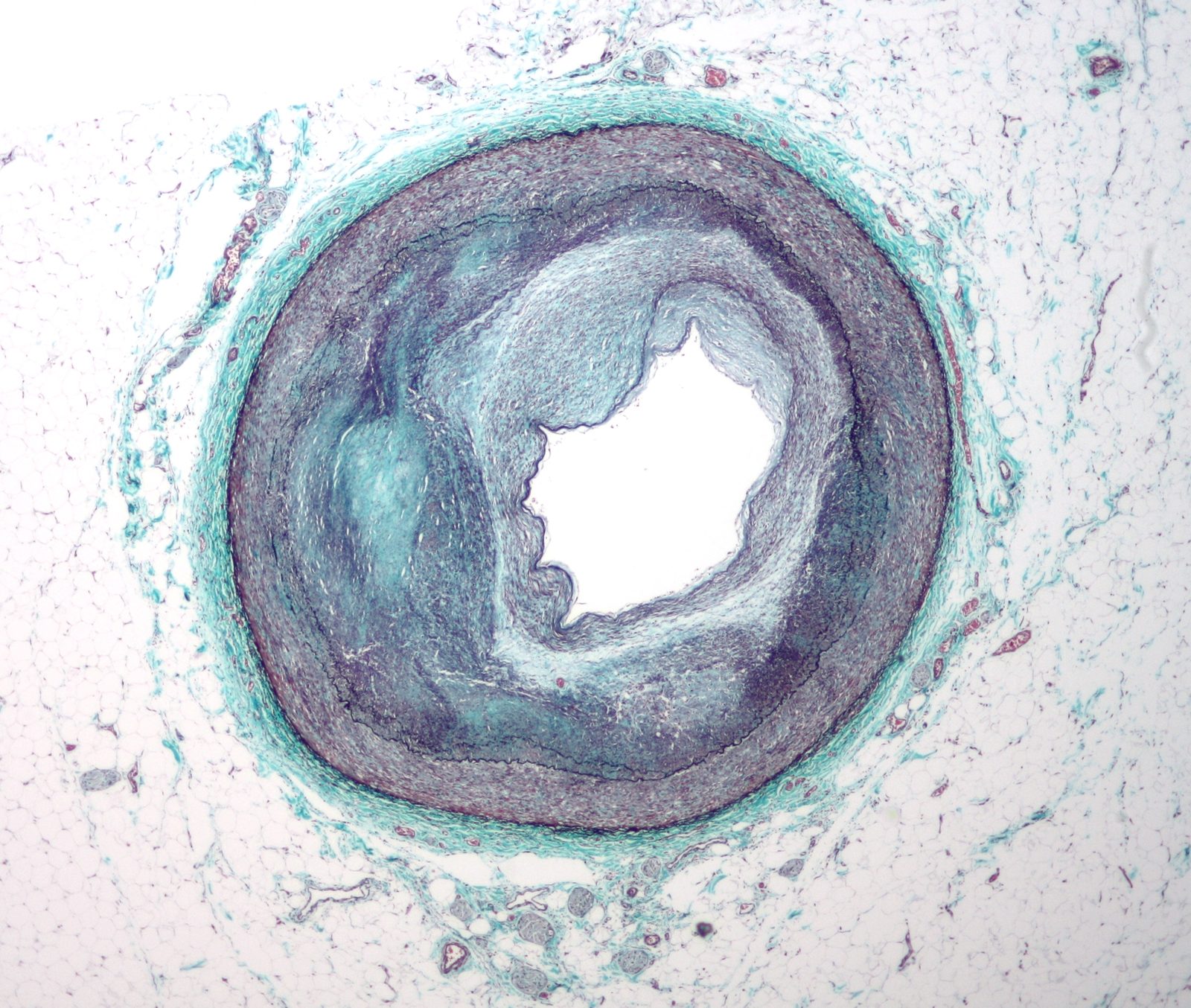 CT coronary angiography image demonstrating an atherosclerotic narrowing of a coronary artery.