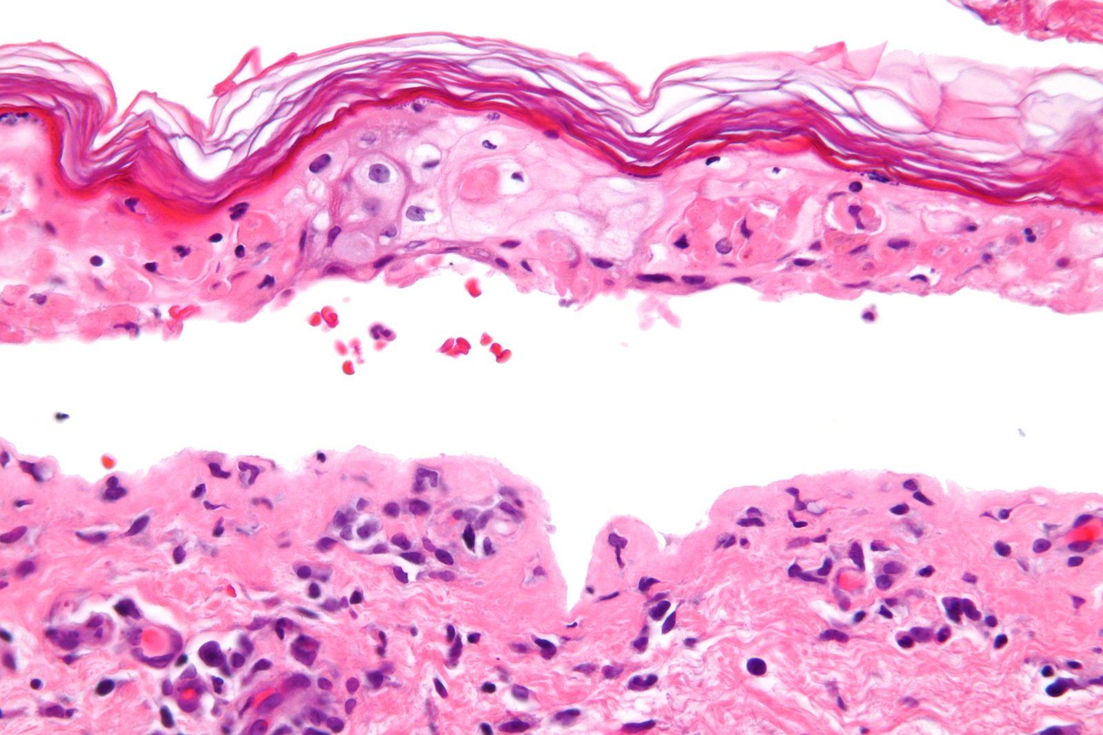 A skin-biopsy micrograph showing confluent full-thickness epidermal necrosis with separation at the dermoepidermal junction, the histological substrate of detachment in SJS/TEN.