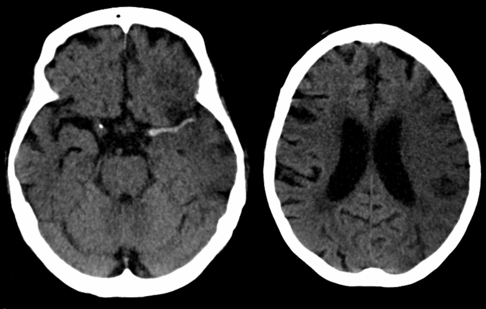 Non-contrast CT of the head performed in acute stroke.