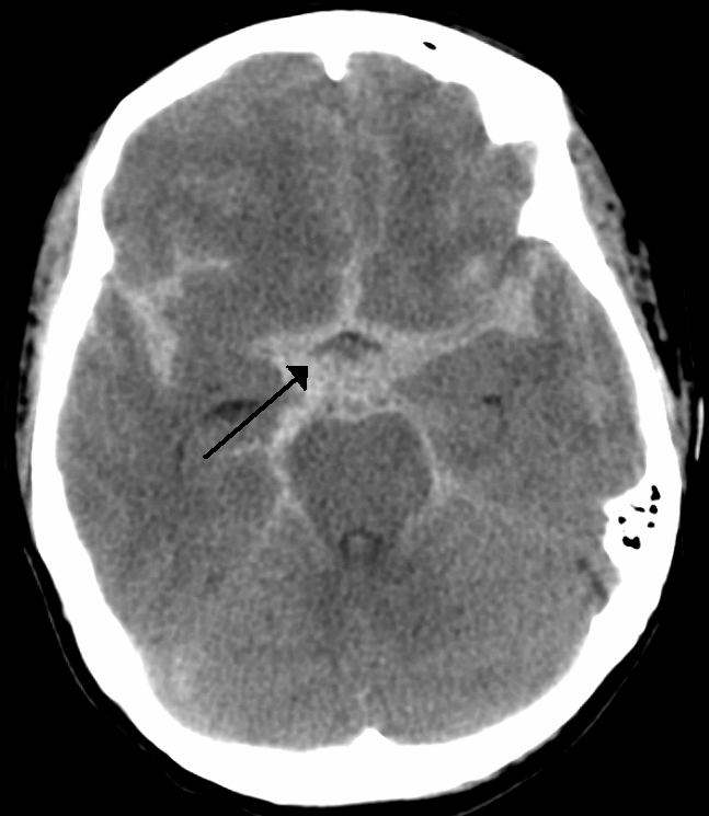 Non-contrast CT image showing hyperdense blood in the basal cisterns and sulci.