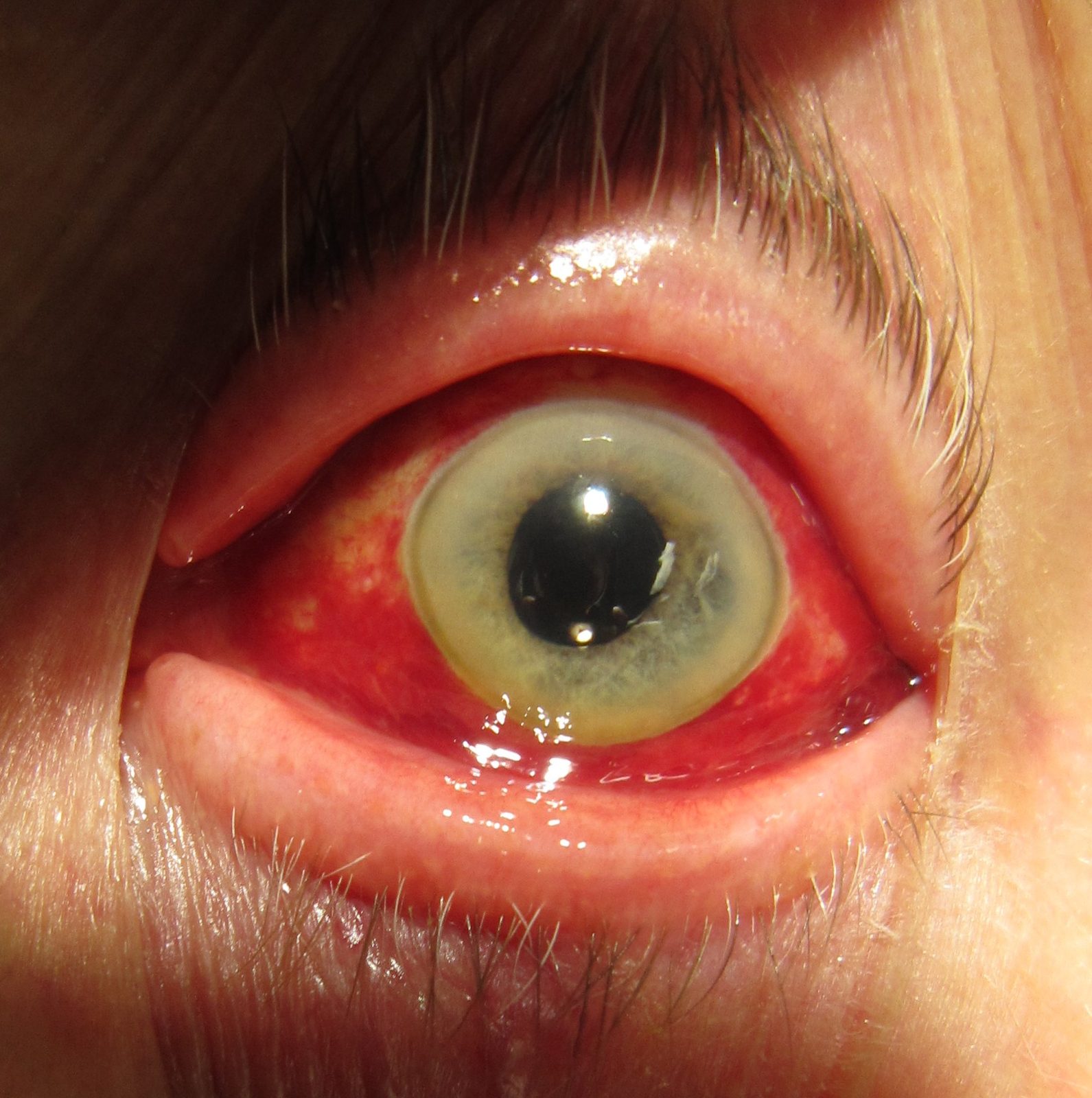 A clinical photograph of a broad bright-red subconjunctival collection surrounding a clear cornea and normal pupil. Label it as an uncomplicated example only when normal vision and absence of trauma are stated.