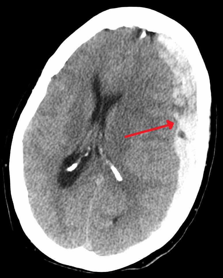 Non-contrast CT showing a hyperdense crescentic collection following the surface of the hemisphere and crossing sutures.