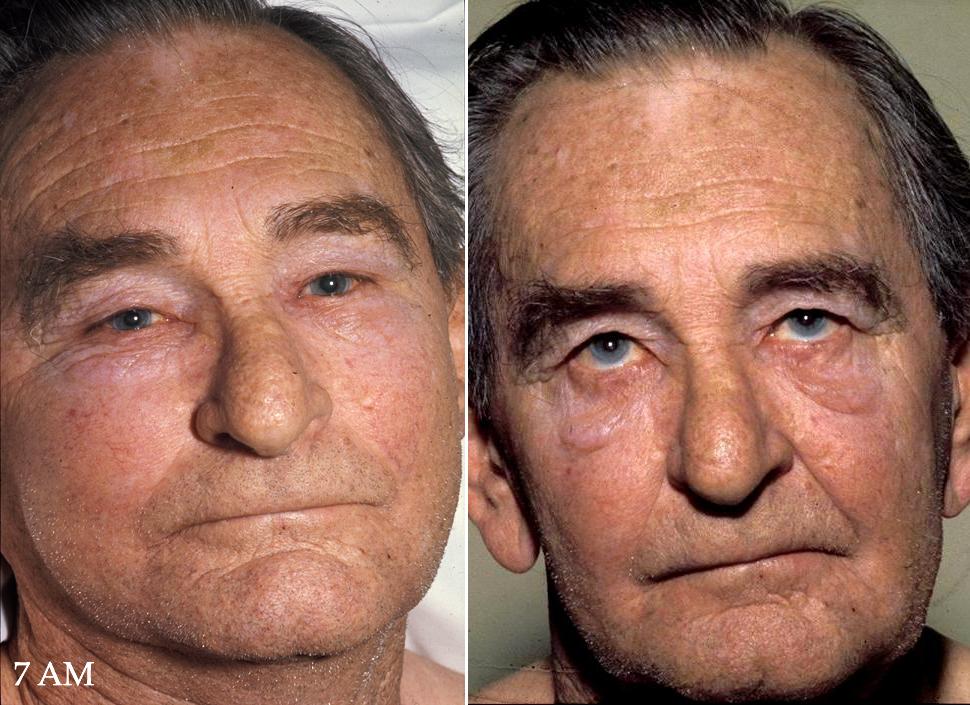 Paired clinical photographs showing facial swelling and venous congestion in superior vena cava obstruction. The appearance should trigger urgent assessment but cannot identify the cause.