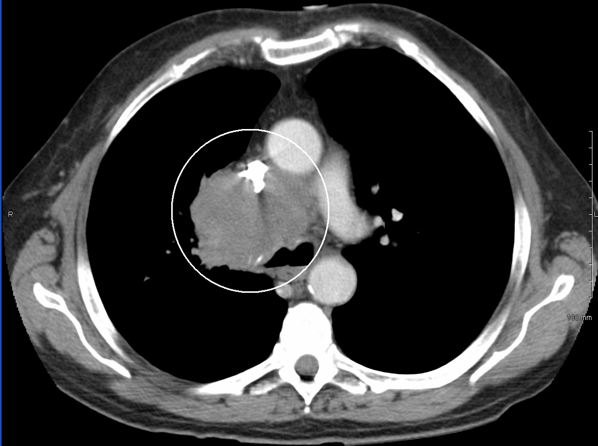 An axial contrast-enhanced CT of the chest showing obstruction of the superior vena cava with a mediastinal process and venous collaterals.