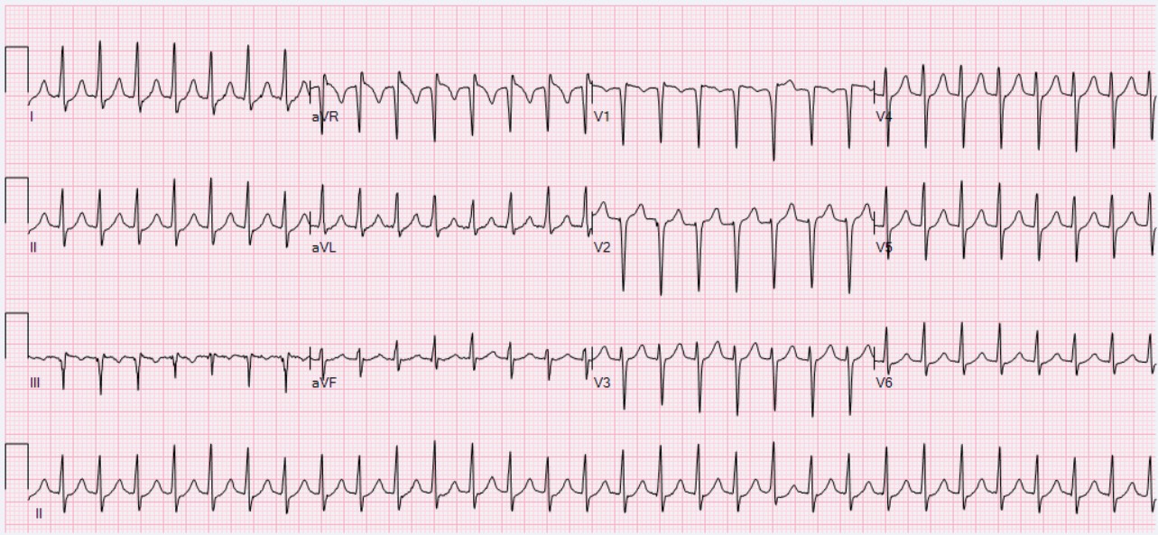 Twelve-lead ECG showing a regular narrow-complex tachycardia at around 180 per minute with no clearly visible P waves, a pattern compatible with AV nodal re-entrant tachycardia but not by itself proof of the exact circuit.