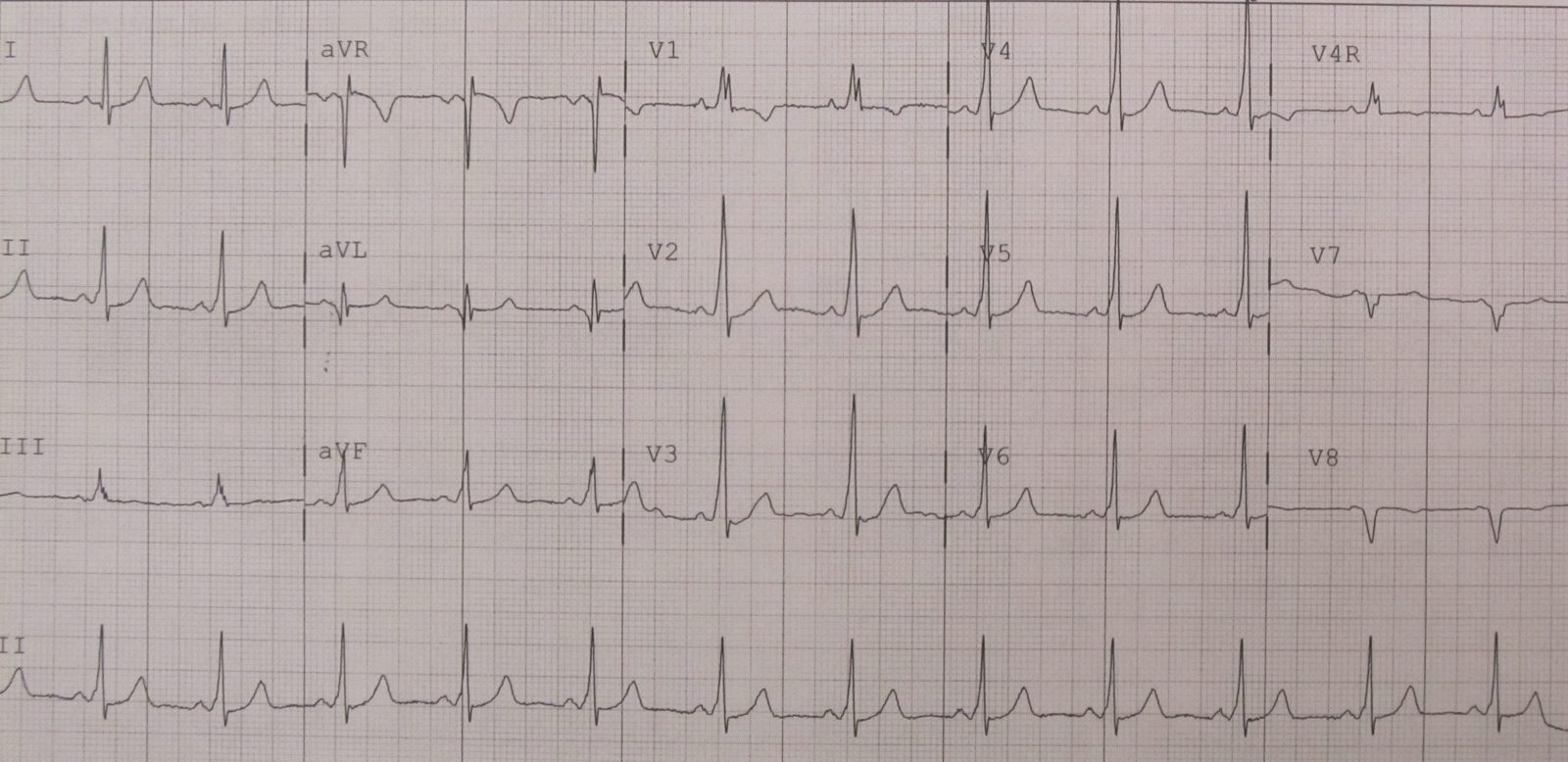 Twelve-lead ECG in sinus rhythm showing a short PR interval and delta wave from ventricular pre-excitation. A normal resting ECG does not exclude AVRT through a concealed accessory pathway.