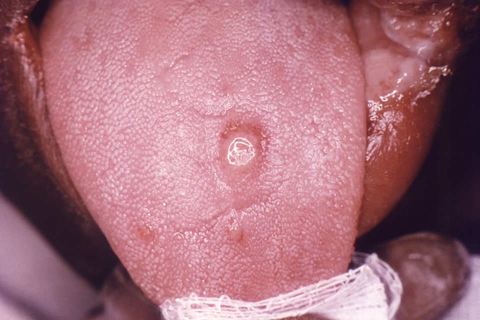 Clinical photograph of a single, painless, indurated chancre on the tongue; primary chancres can occur at extragenital sites of inoculation.