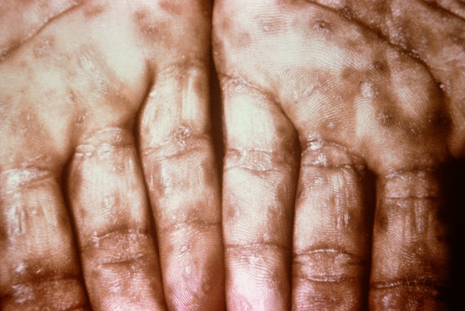 Clinical photograph of a secondary syphilis rash involving the palms, illustrating the classic but not universal distribution.