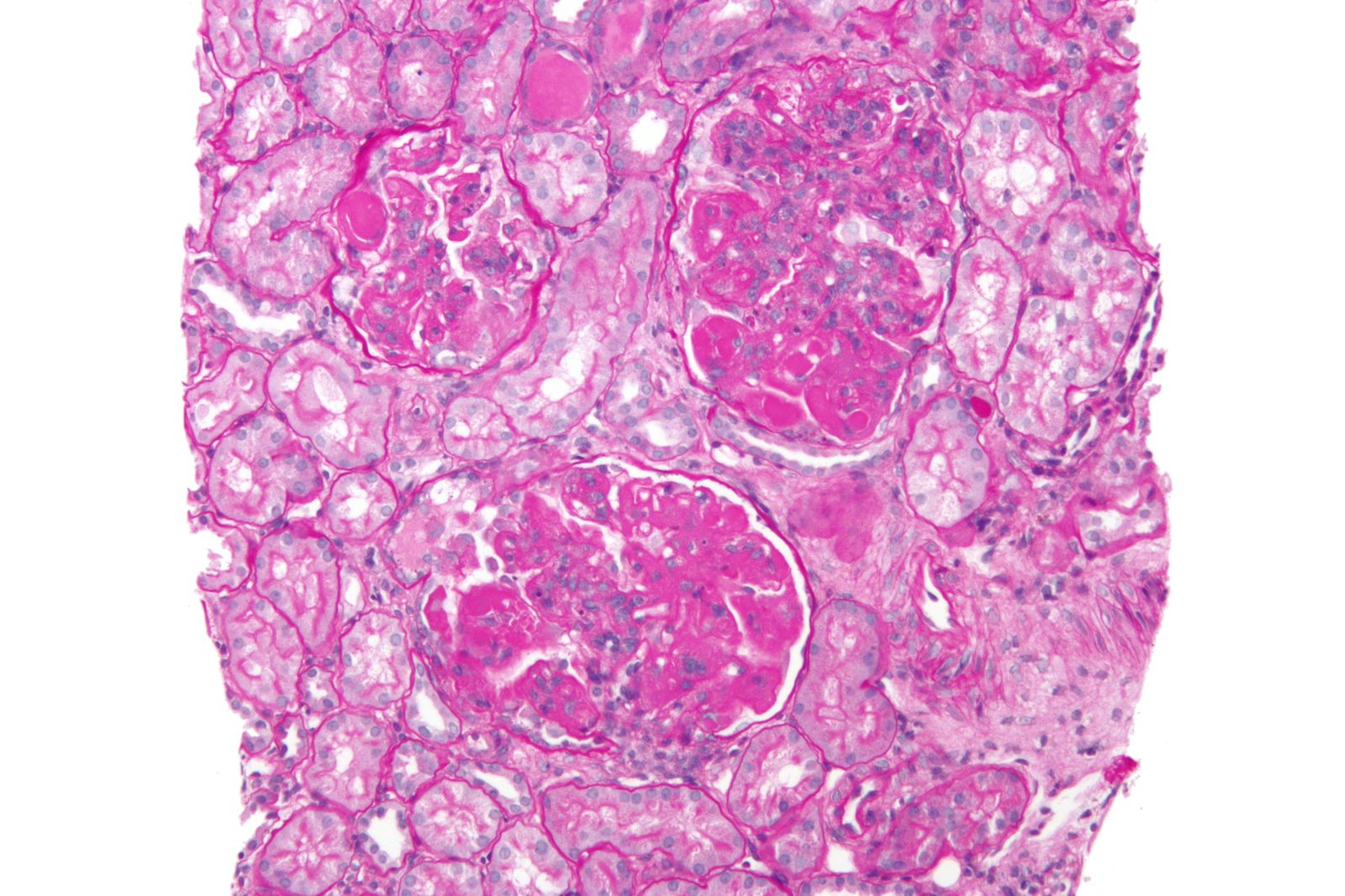 Histology image of immune complex glomerulonephritis with characteristic full-house immunofluorescence staining seen in lupus nephritis.