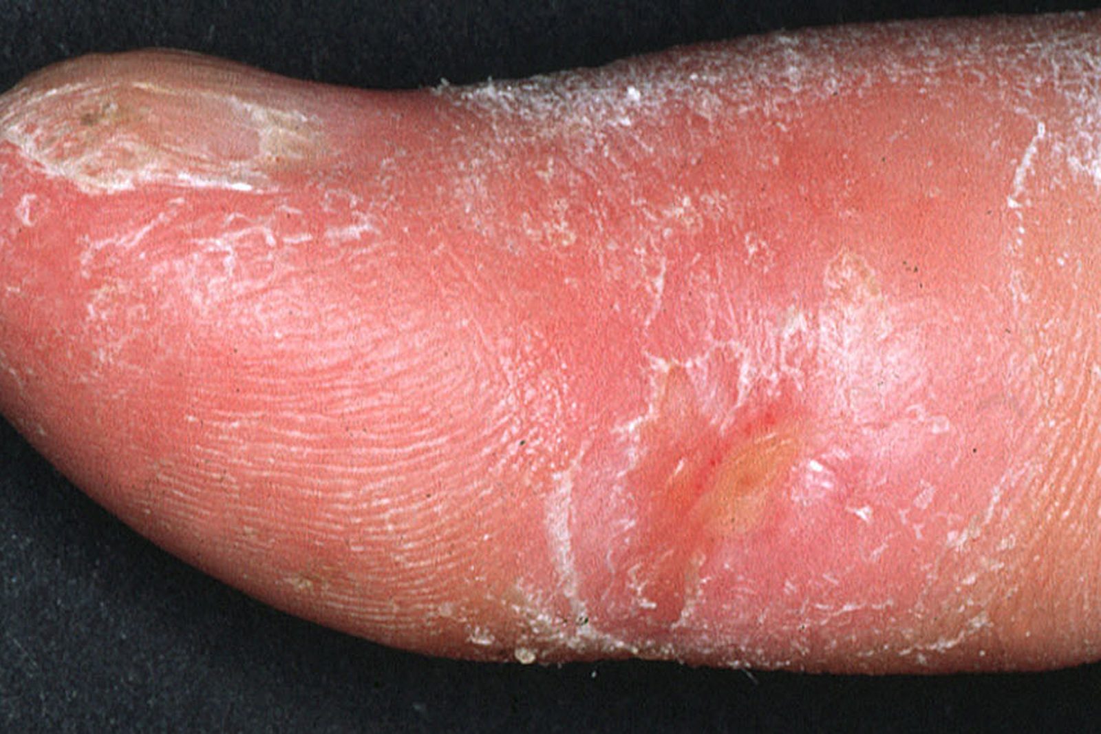 Close clinical photograph showing taut shiny sclerodactyly, scaling and focal digital tissue injury in systemic sclerosis. Use consented or openly licensed educational imagery and avoid implying that every person develops ulceration.