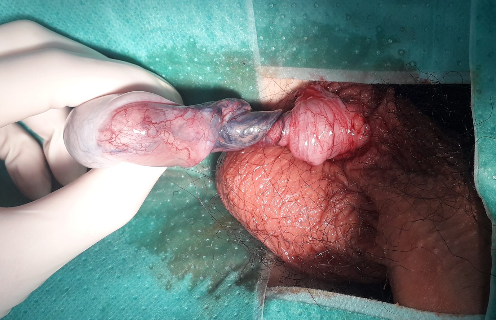 Intra-operative view of a torted, congested testis during scrotal exploration.