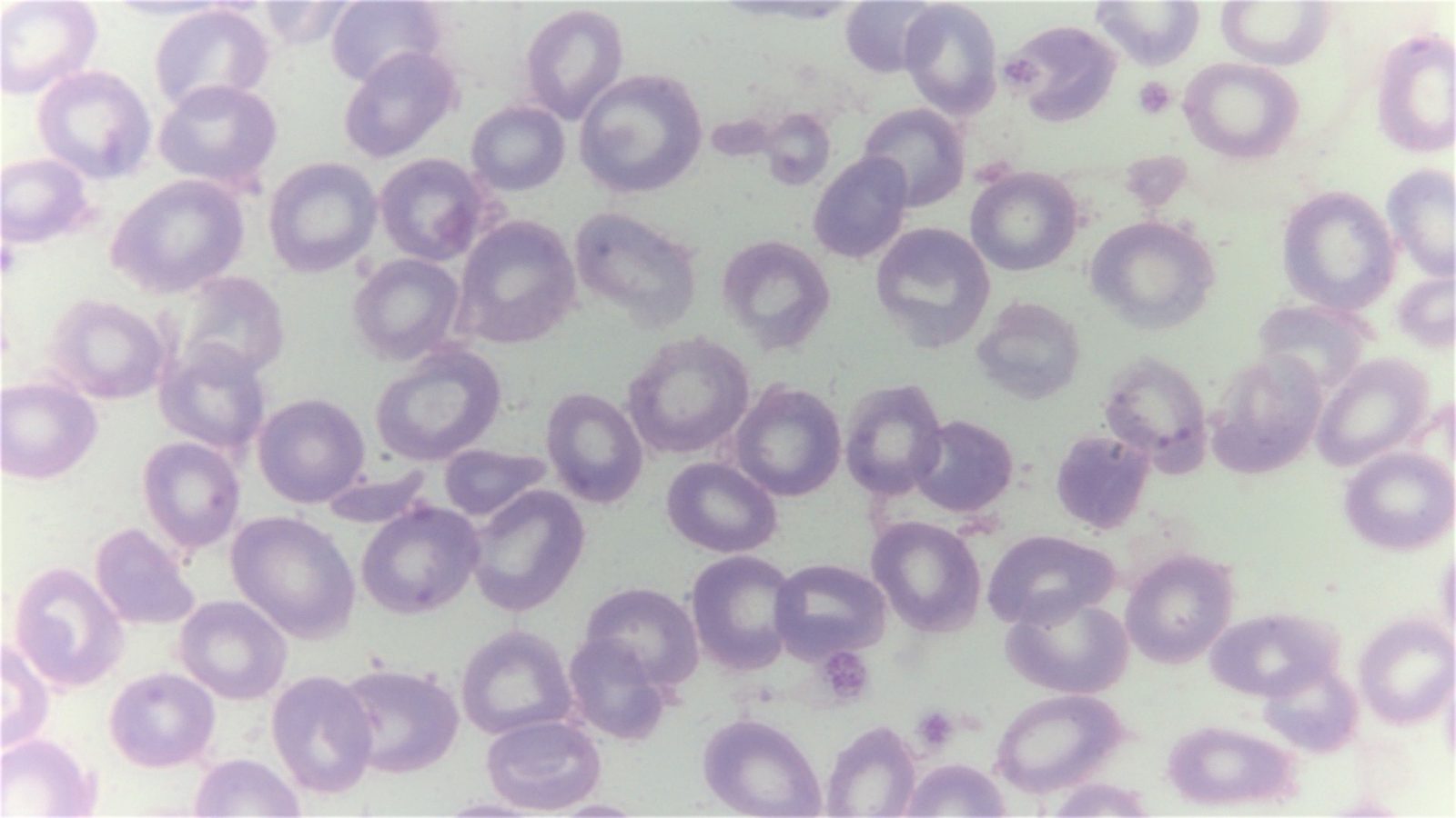 A blood film showing microcytic hypochromic red cells with target cells and, in major disease, nucleated red cells and basophilic stippling.