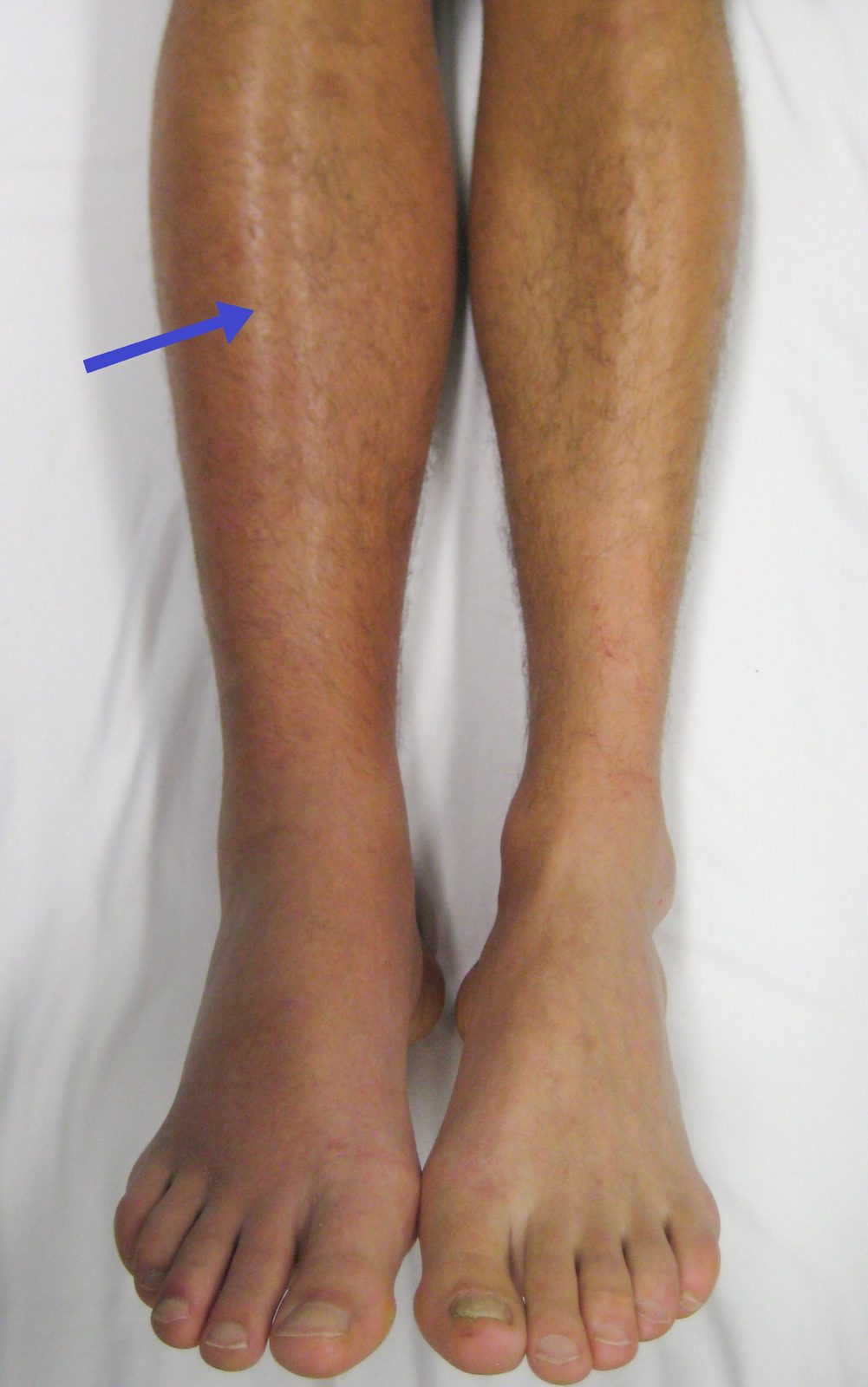 Clinical photograph showing unilateral swelling and erythema of the right lower leg from deep vein thrombosis, an important presentation in patients with inherited or acquired thrombophilia.
